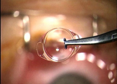 implante de lente facica em curitiba